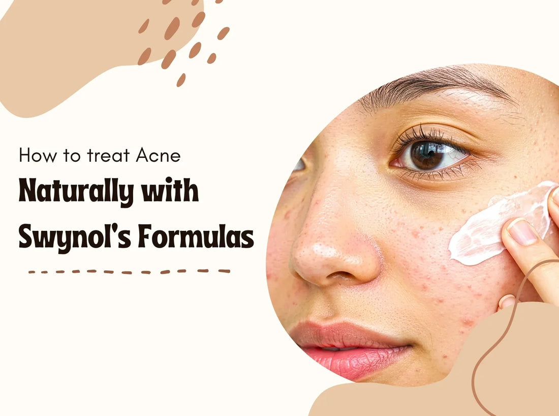 How to Treat Acne Naturally with Swynol’s Gentle Formulas